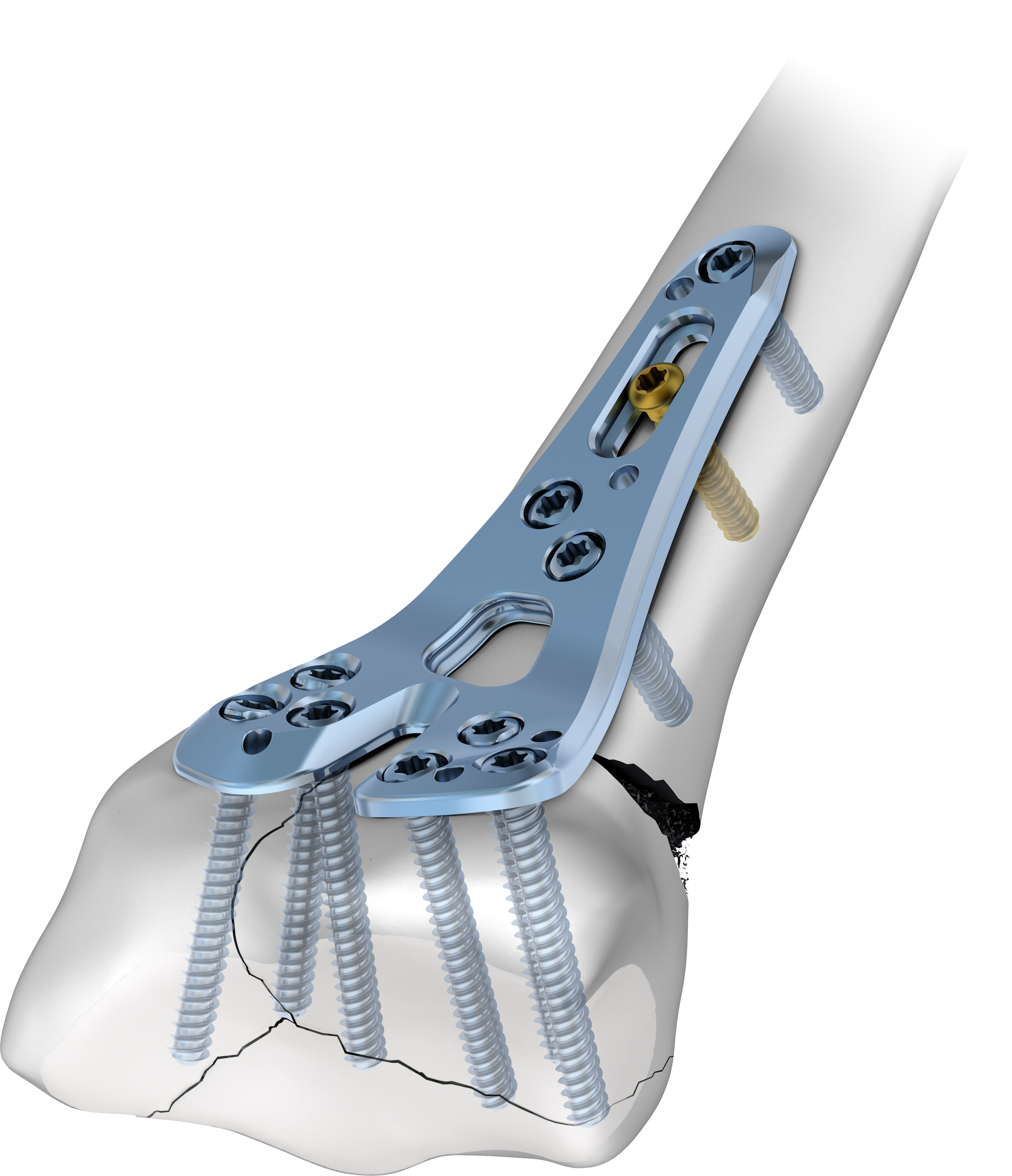 Fissatore ibrido nuovo concetto - Dispositivi ortopedici e postoperatori